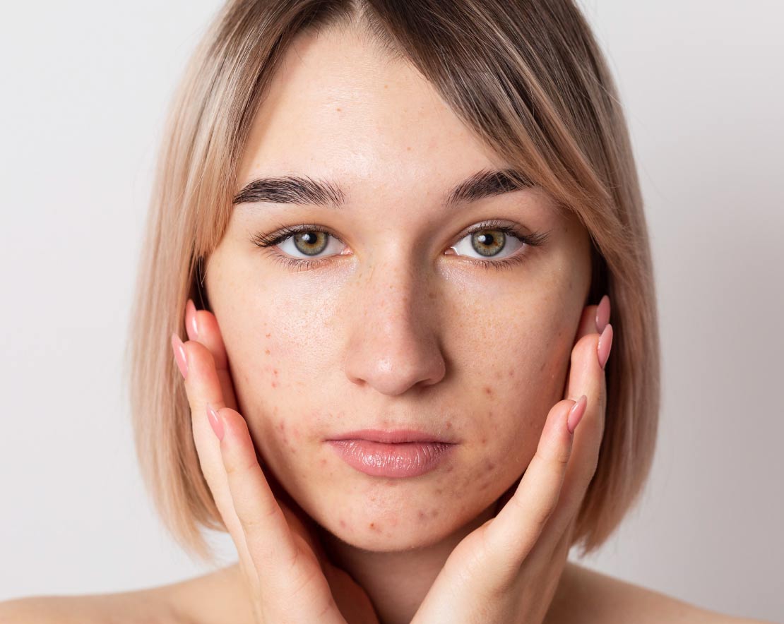 Manchas en la cara: cómo quitarlas o disminuir su pigmentación