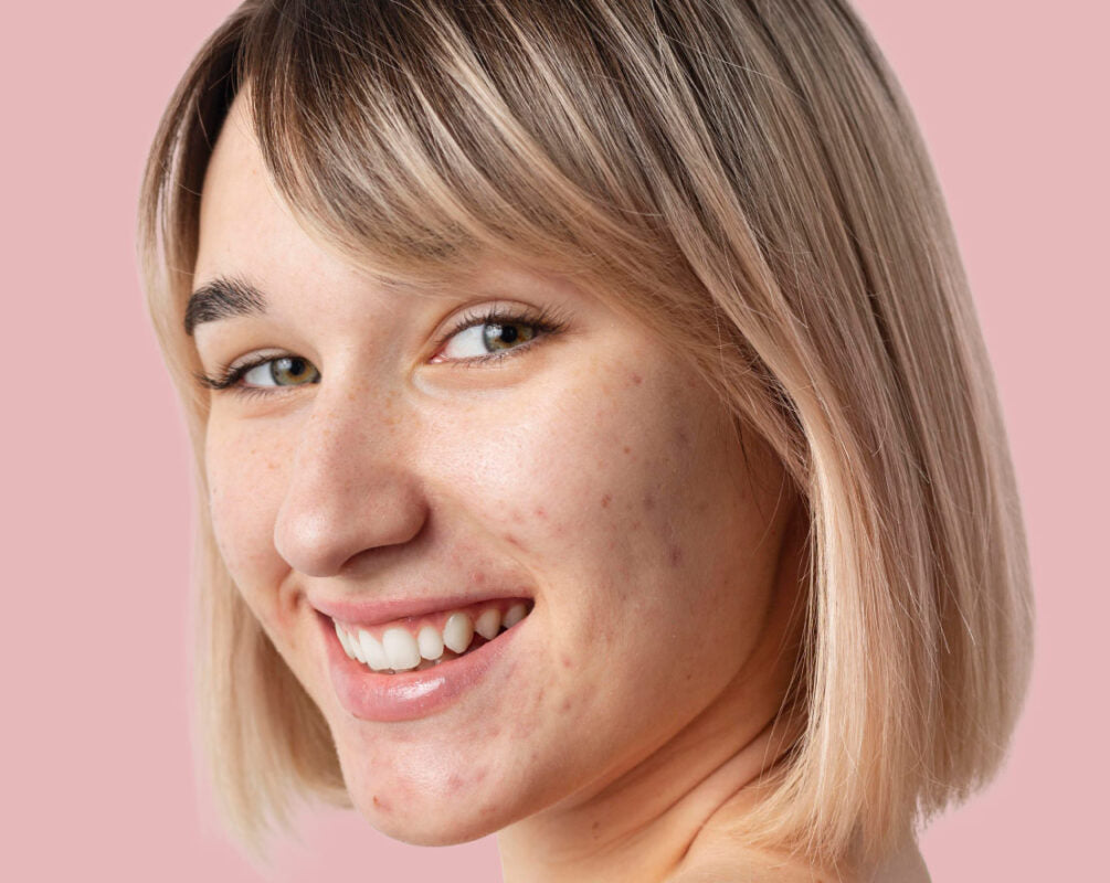 ¿Qué es el acné? Principales causas, síntomas y tratamientos