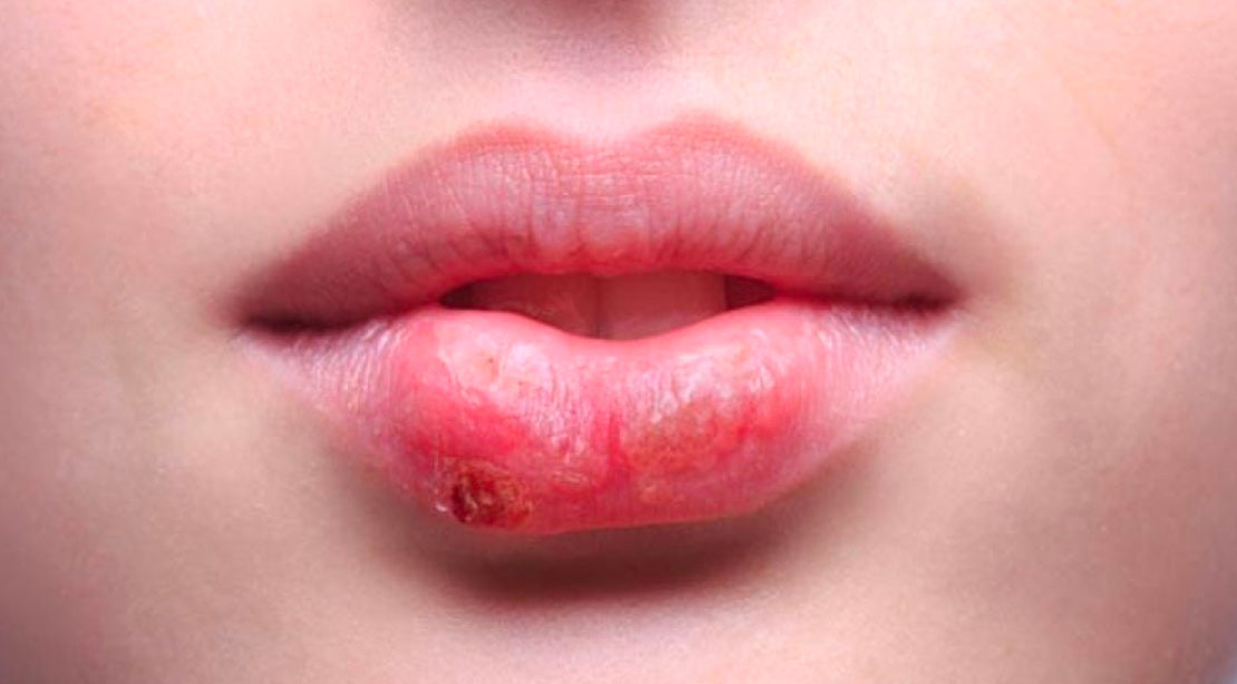 Herpes labial: qué es, síntomas, cómo tratarlo y prevenir que aparezca