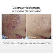 Kit Piel Grasa y Poros