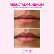 Sugar Kiss resultados reales antes y despues