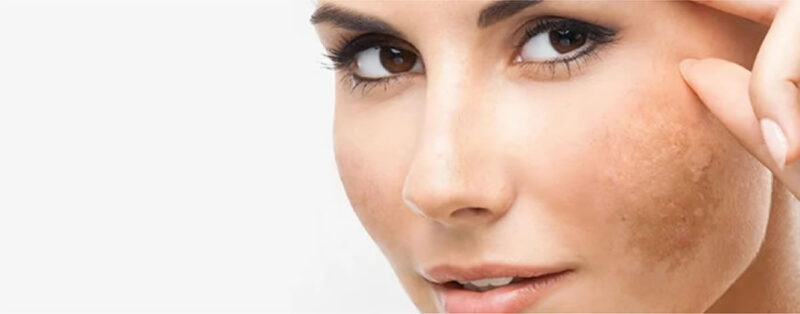 como-disminuir-manchas-en-la-cara