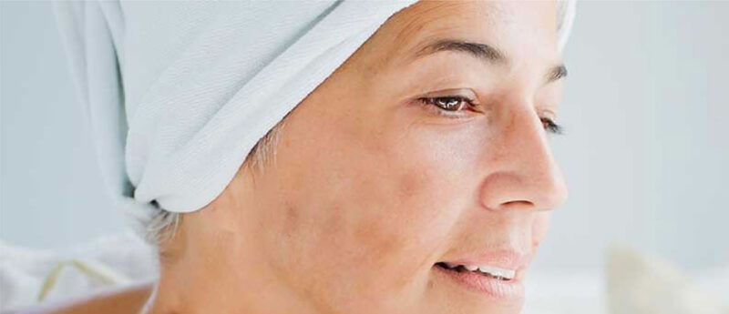 manchas-en-la-piel-infinitek