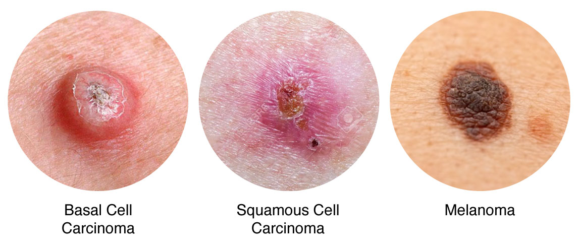 skin cancer symptoms pictures and signs