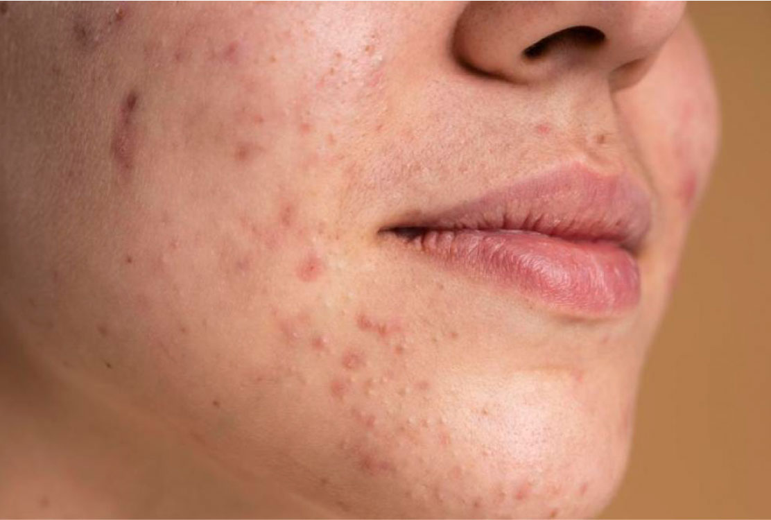 en Orden alfabetico bañera Cómo prevenir el acné y cuidar tu rostro de los molestos granitos