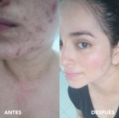 testimonio mujer infinitek paris, cambios reales en acne, arrugas, ojeras, piel, rostro, cuidado facial