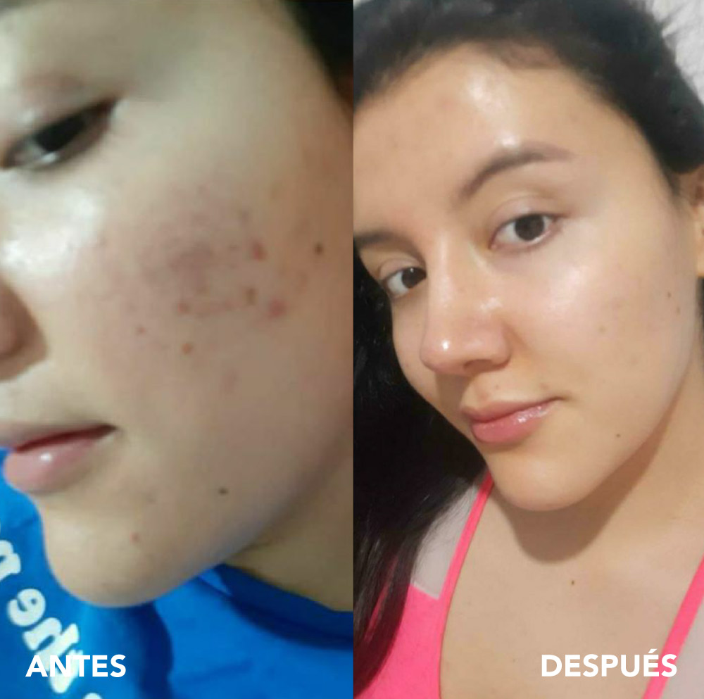 testimonio mujer infinitek paris, cambios reales en acne, arrugas, ojeras, piel, rostro, cuidado facial