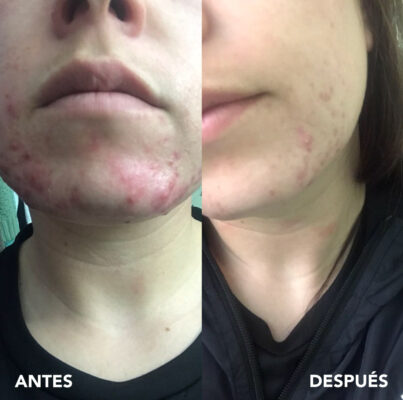 testimonio mujer infinitek paris, cambios reales en acne, arrugas, ojeras, piel, rostro, cuidado facial