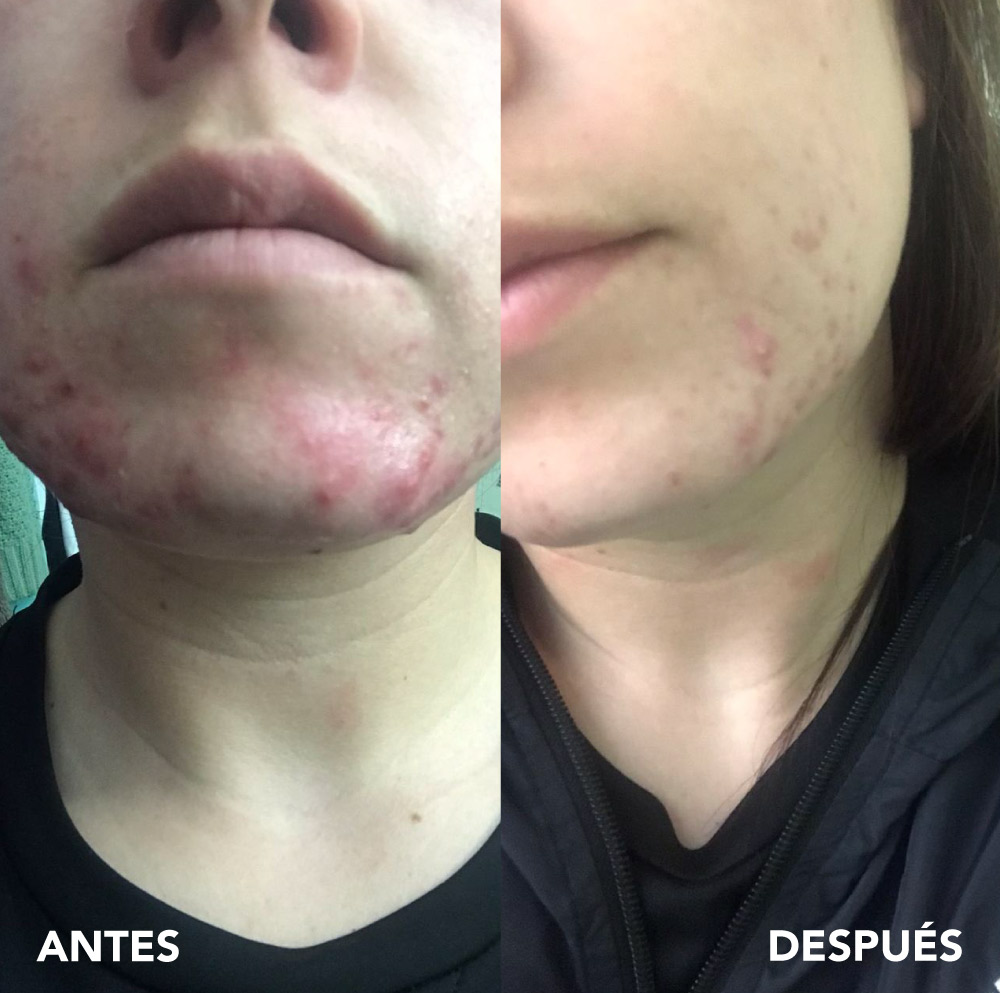 testimonio mujer infinitek paris, cambios reales en acne, arrugas, ojeras, piel, rostro, cuidado facial