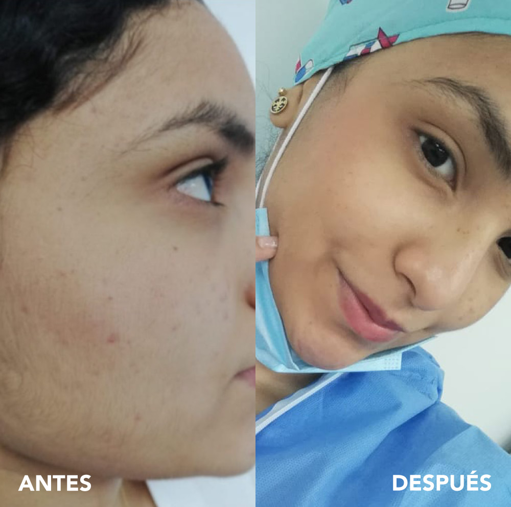 testimonio mujer infinitek paris, cambios reales en acne, arrugas, ojeras, piel, rostro, cuidado facial
