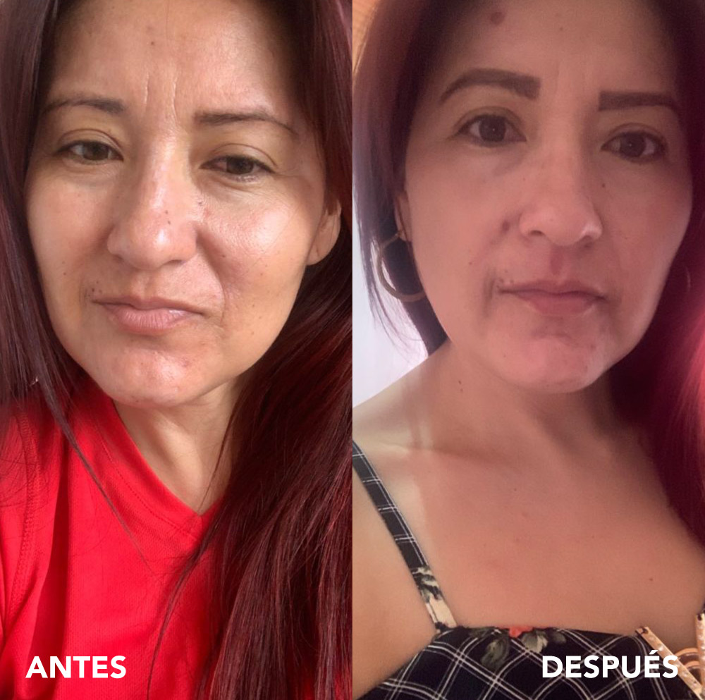testimonio mujer infinitek paris, cambios reales en acne, arrugas, ojeras, piel, rostro, cuidado facial