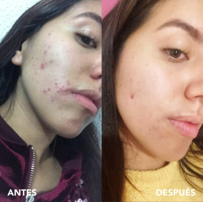 testimonio mujer infinitek paris, cambios reales en acne, arrugas, ojeras, piel, rostro, cuidado facial