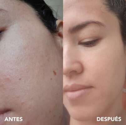 testimonio mujer infinitek paris, cambios reales en acne, arrugas, ojeras, piel, rostro, cuidado facial
