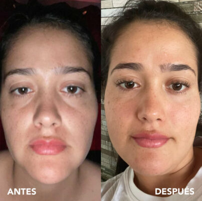 testimonio mujer infinitek paris, cambios reales en acne, arrugas, ojeras, piel, rostro, cuidado facial
