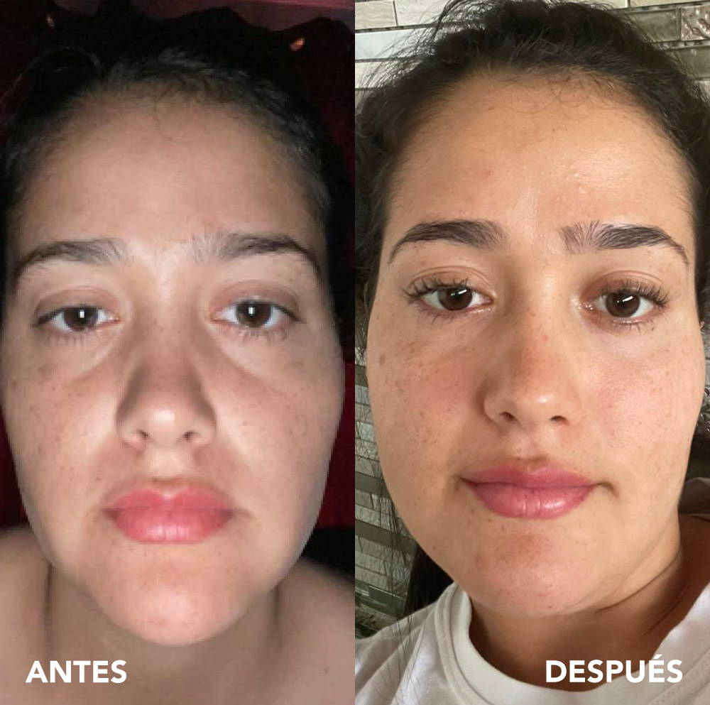 testimonio mujer infinitek paris, cambios reales en acne, arrugas, ojeras, piel, rostro, cuidado facial