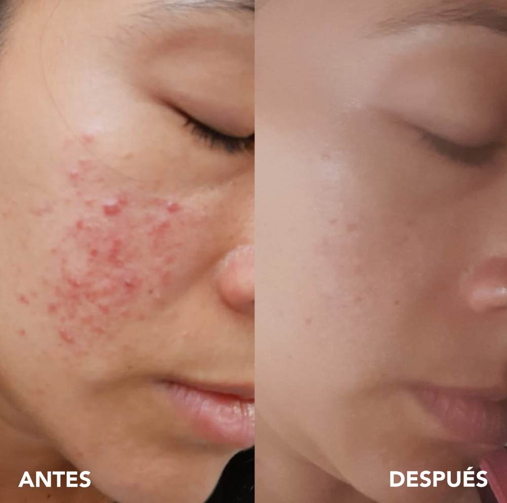 testimonio mujer infinitek paris, cambios reales en acne, arrugas, ojeras, piel, rostro, cuidado facial
