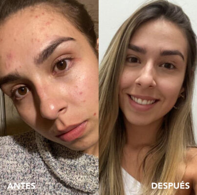 testimonio mujer infinitek paris, cambios reales en acne, arrugas, ojeras, piel, rostro, cuidado facial