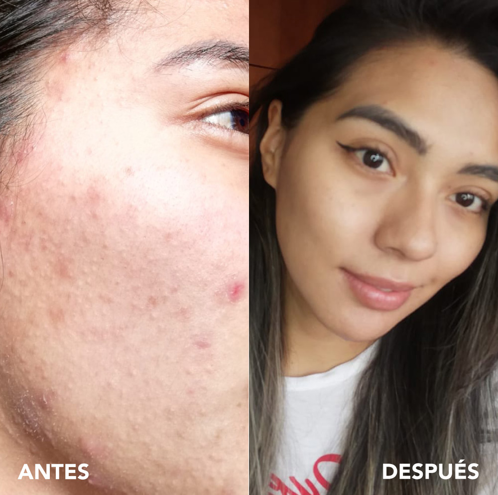 testimonio mujer infinitek paris, cambios reales en acne, arrugas, ojeras, piel, rostro, cuidado facial