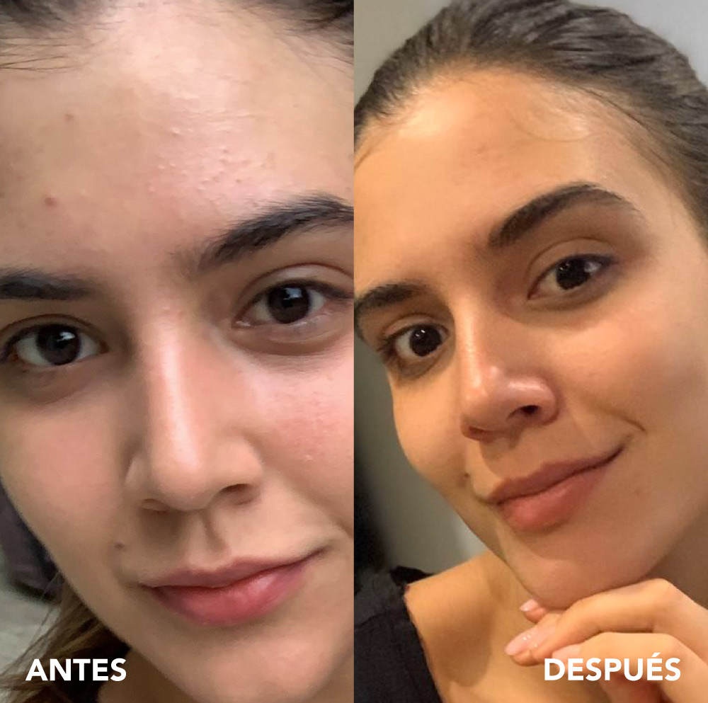 testimonio mujer infinitek paris, cambios reales en acne, arrugas, ojeras, piel, rostro, cuidado facial