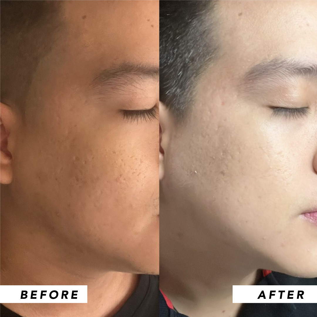 Infinitek Paris man's testimony: real changes in acne, wrinkles, dark circles, skin, face, facial care