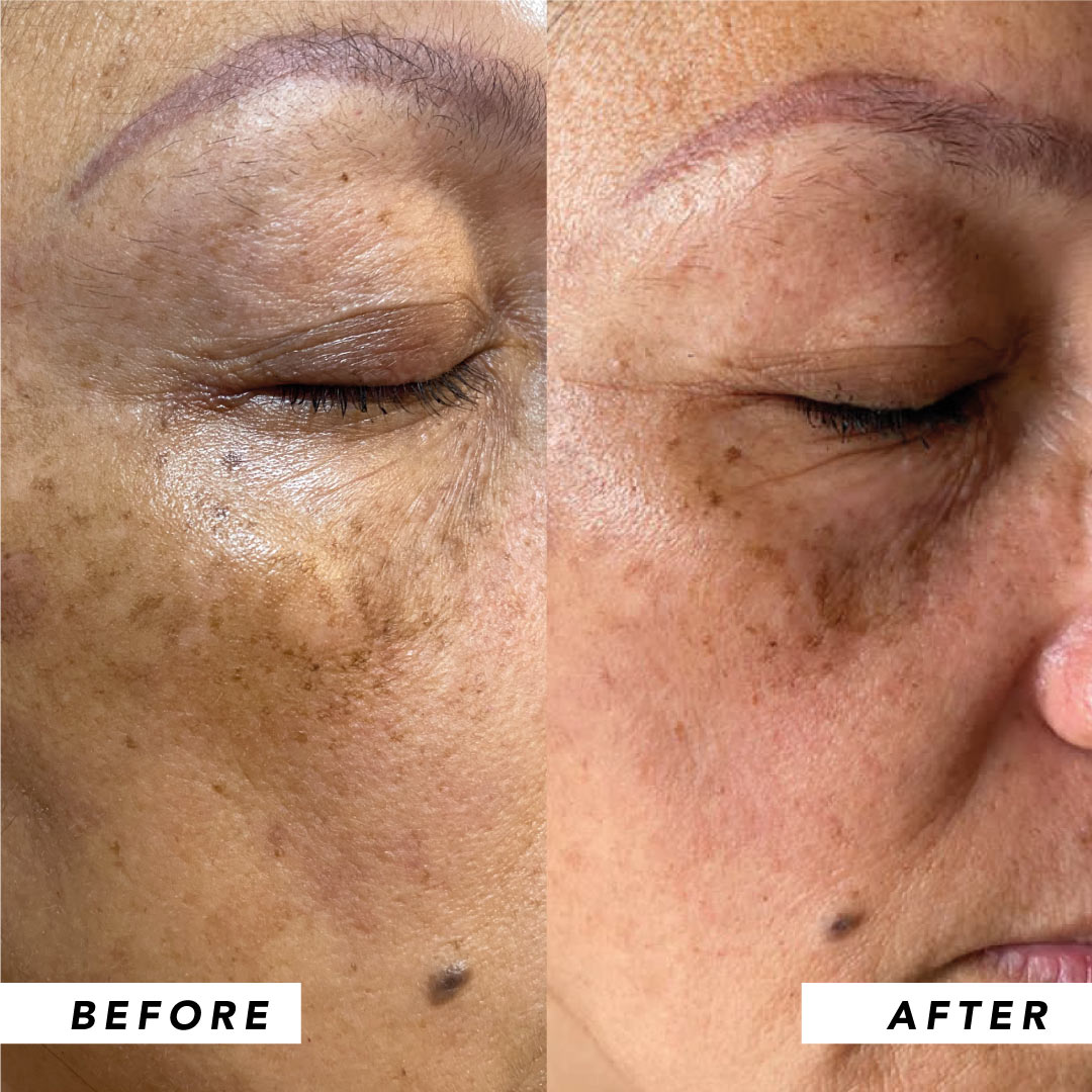 Infinitek Paris woman's testimony: real changes in acne, wrinkles, dark circles, skin, face, facial care