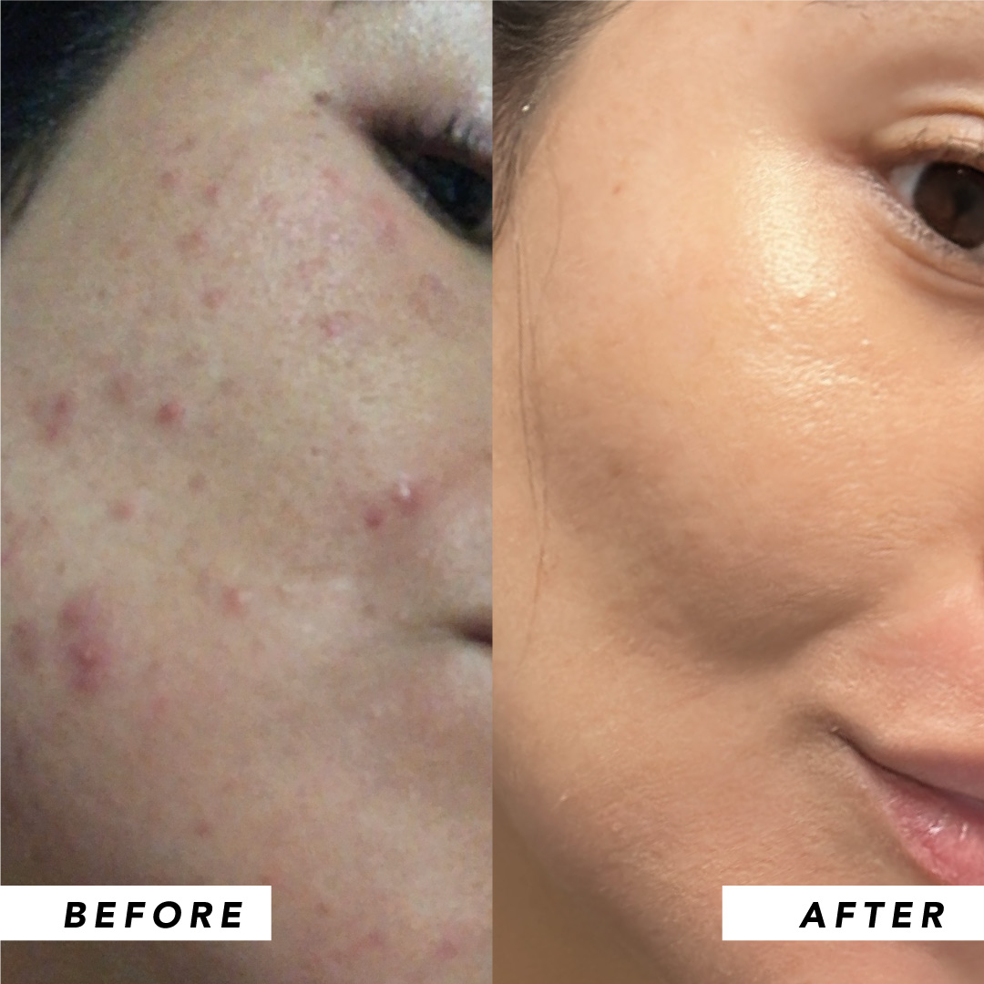 Infinitek Paris woman's testimony: real changes in acne, wrinkles, dark circles, skin, face, facial care