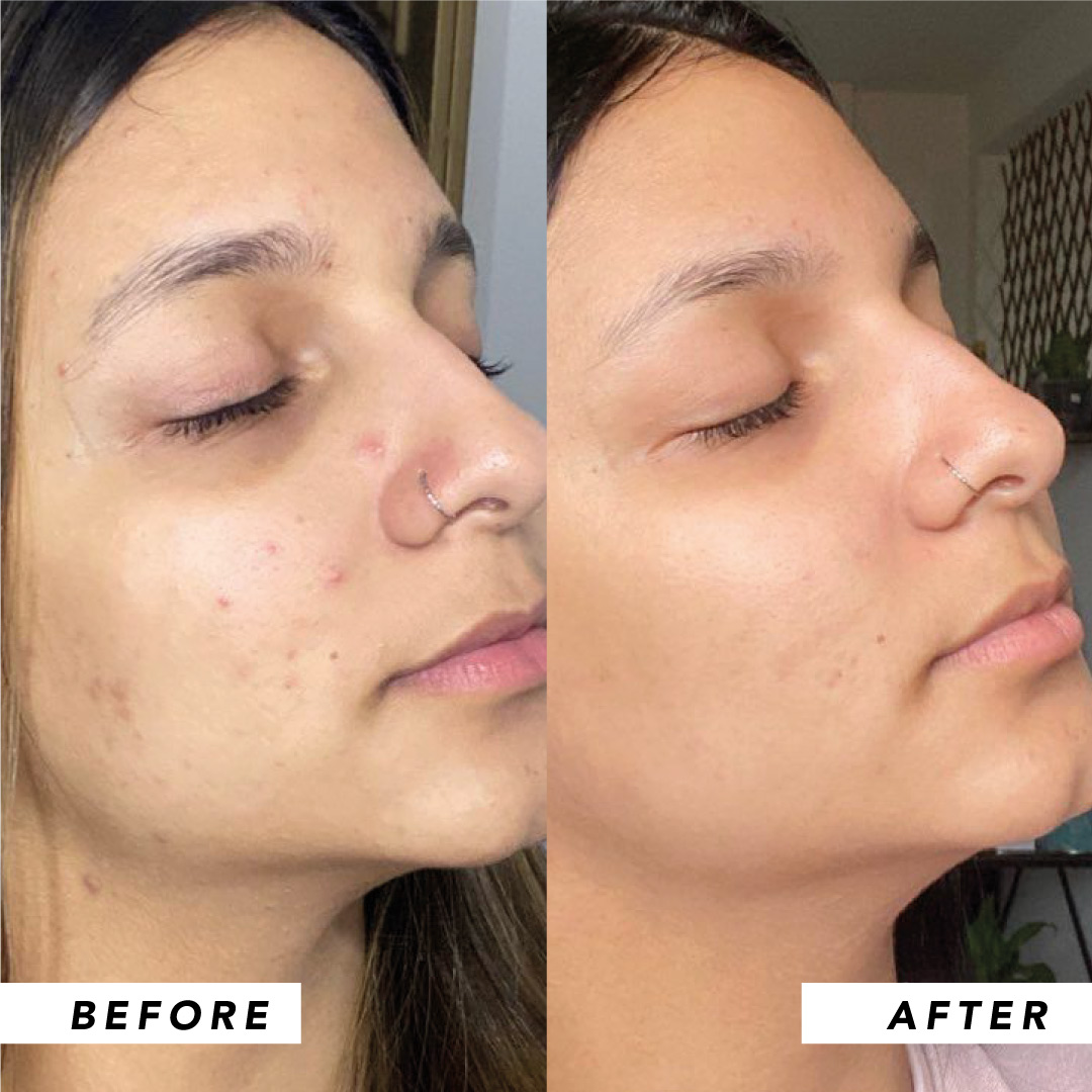 Infinitek Paris woman's testimony: real changes in acne, wrinkles, dark circles, skin, face, facial care