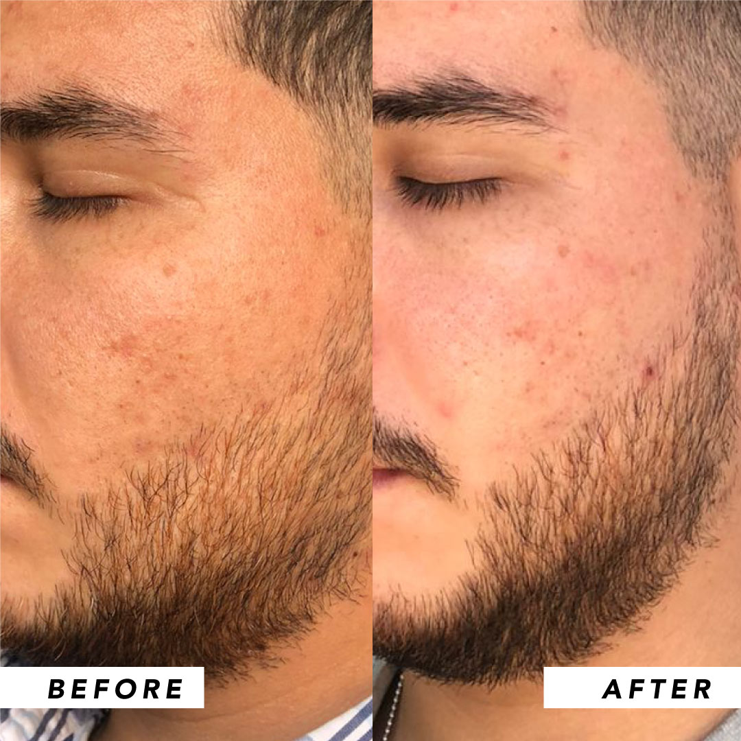 Infinitek Paris man's testimony: real changes in acne, wrinkles, dark circles, skin, face, facial care
