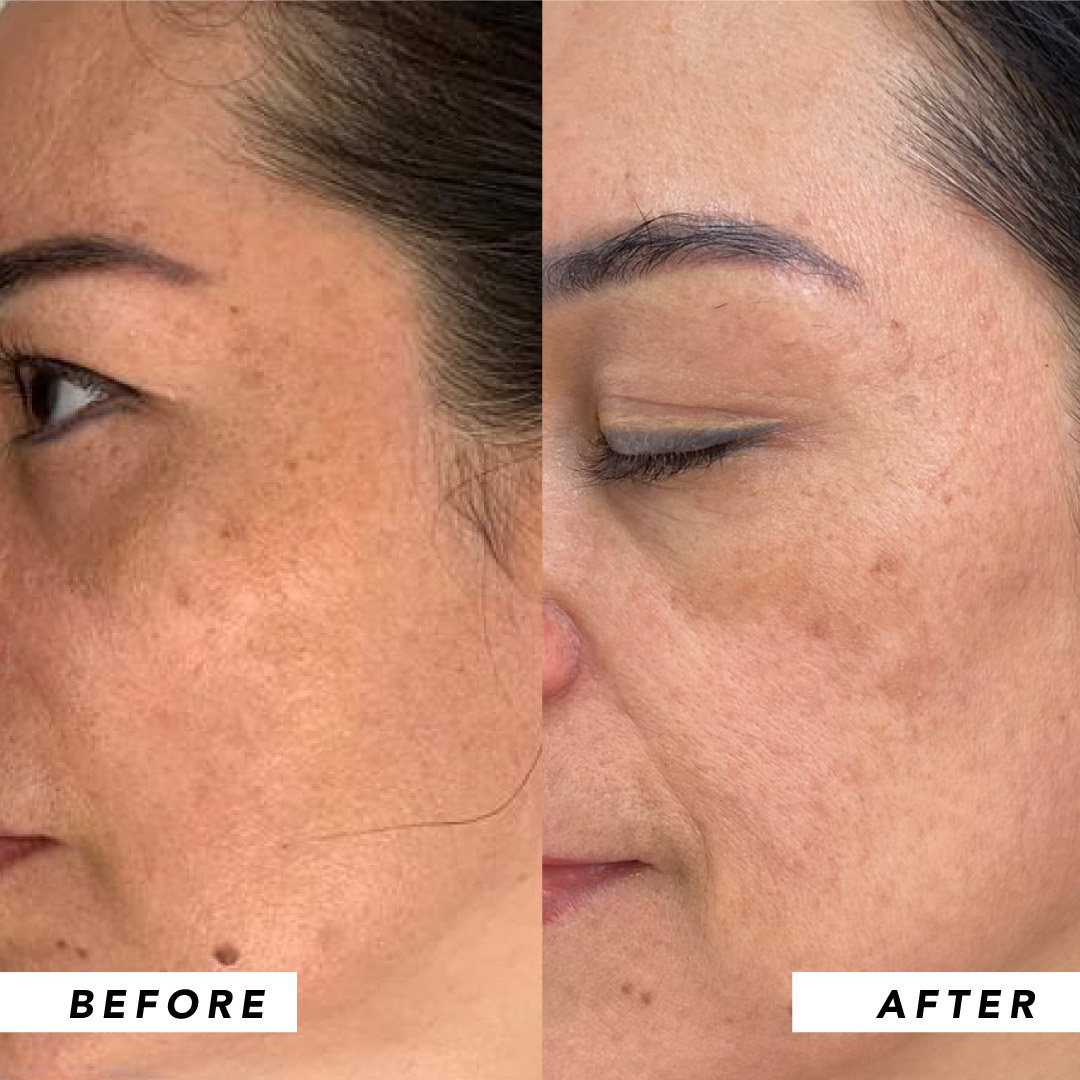 Infinitek Paris woman's testimony: real changes in acne, wrinkles, dark circles, skin, face, facial care