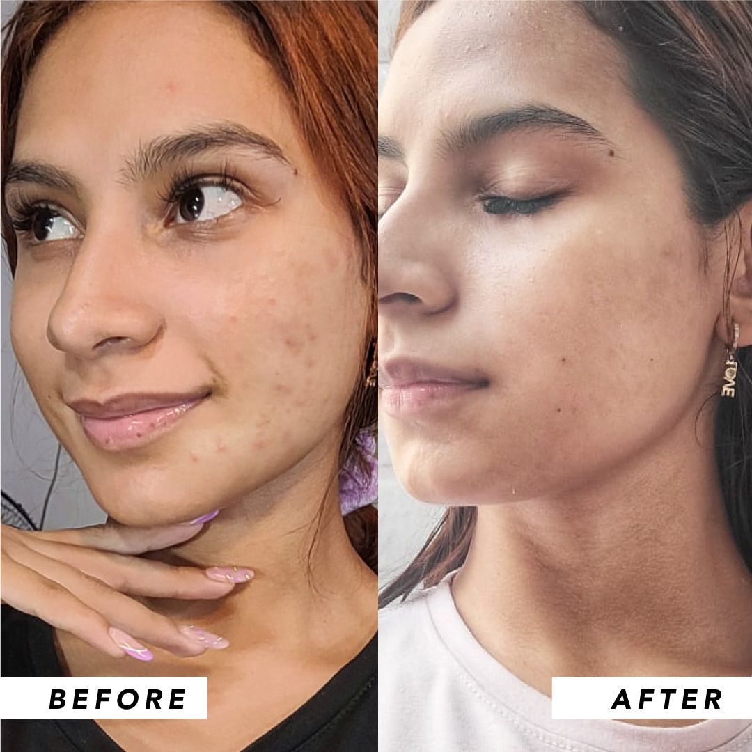 Infinitek Paris woman's testimony: real changes in acne, wrinkles, dark circles, skin, face, facial care