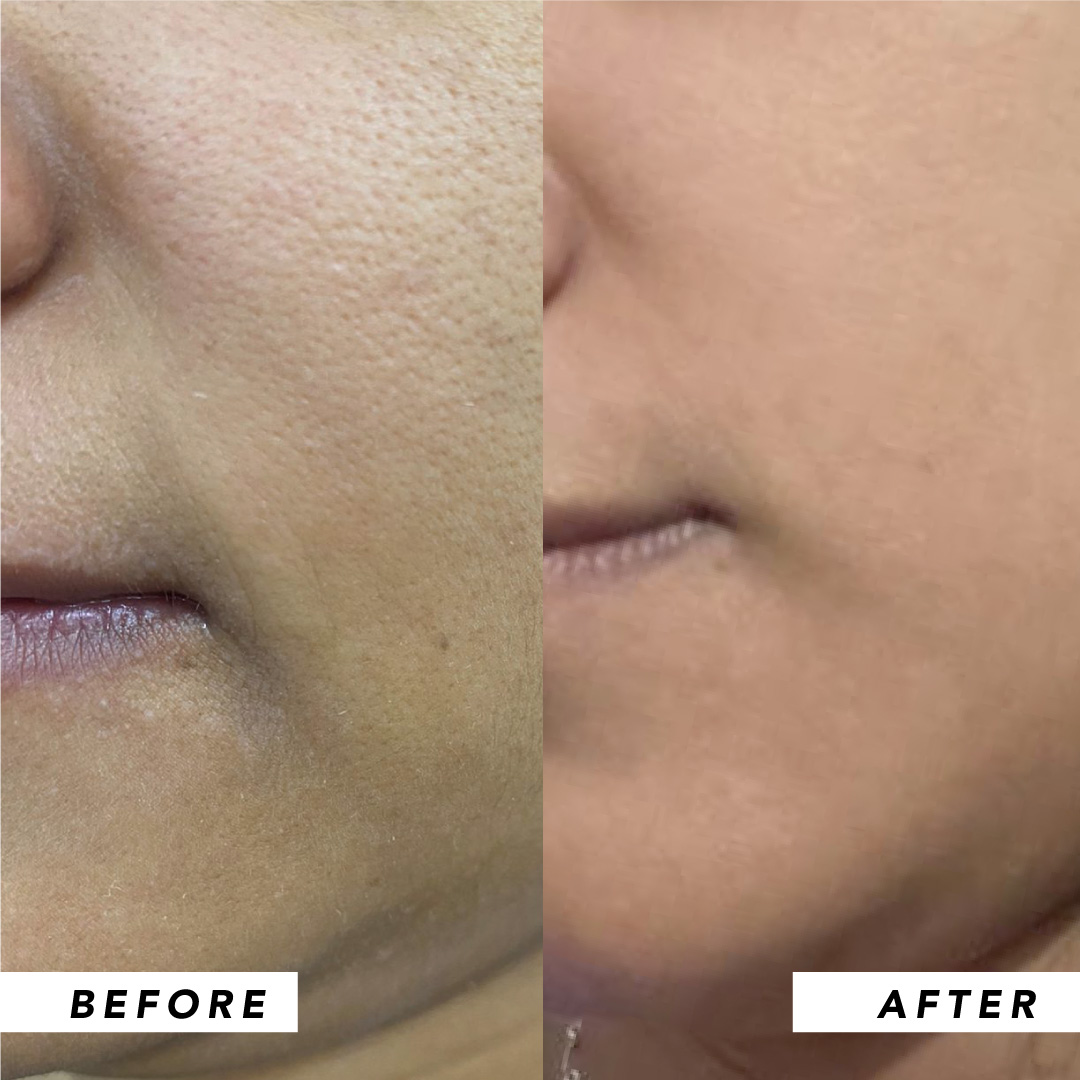 Infinitek Paris woman's testimony: real changes in acne, wrinkles, dark circles, skin, face, facial care