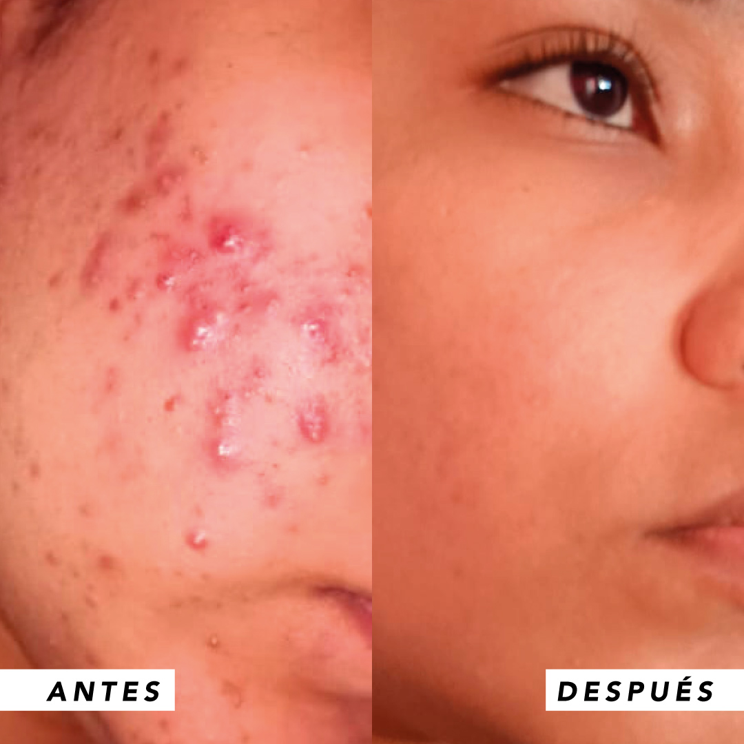 testimonio mujer infinitek paris, cambios reales en acne, arrugas, ojeras, piel, rostro, cuidado facial