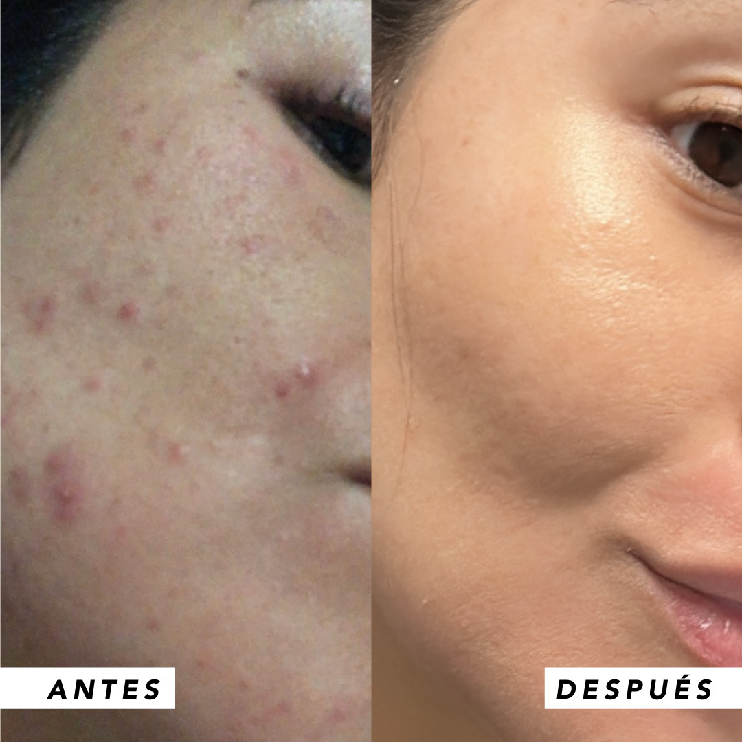 testimonio mujer infinitek paris, cambios reales en acne, arrugas, ojeras, piel, rostro, cuidado facial