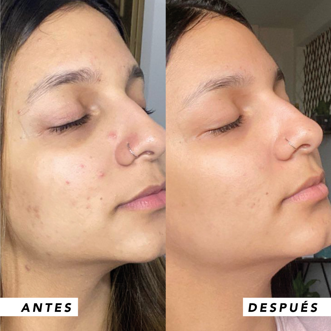 testimonio mujer infinitek paris, cambios reales en acne, arrugas, ojeras, piel, rostro, cuidado facial