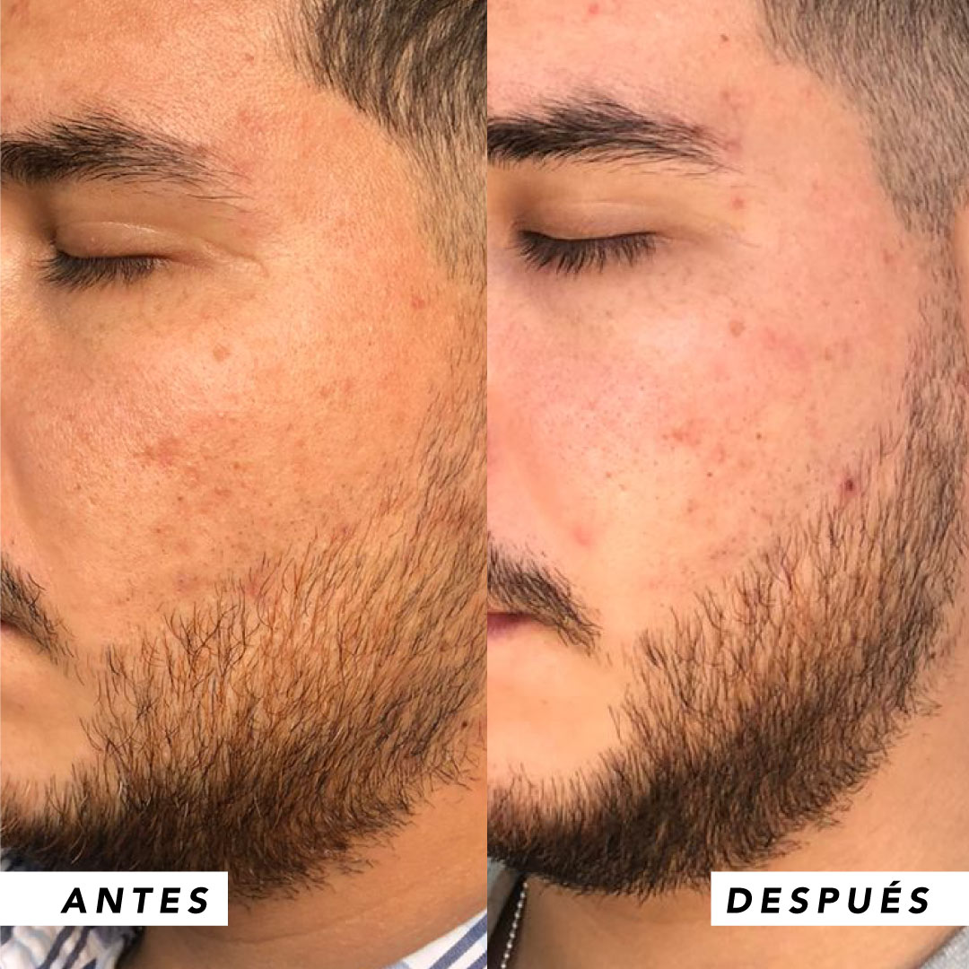 testimonio mujer infinitek paris, cambios reales en acne, arrugas, ojeras, piel, rostro, cuidado facial