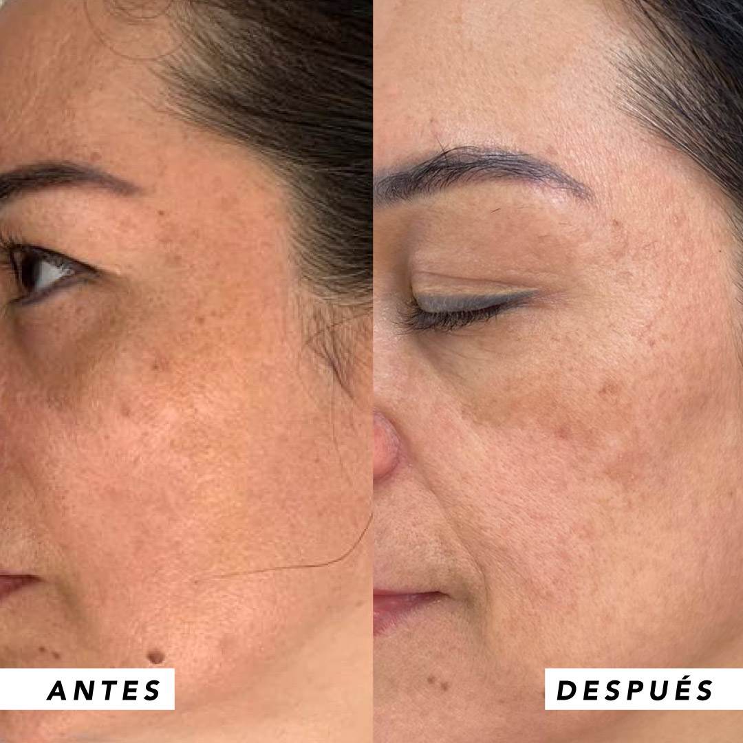 testimonio mujer infinitek paris, cambios reales en acne, arrugas, ojeras, piel, rostro, cuidado facial