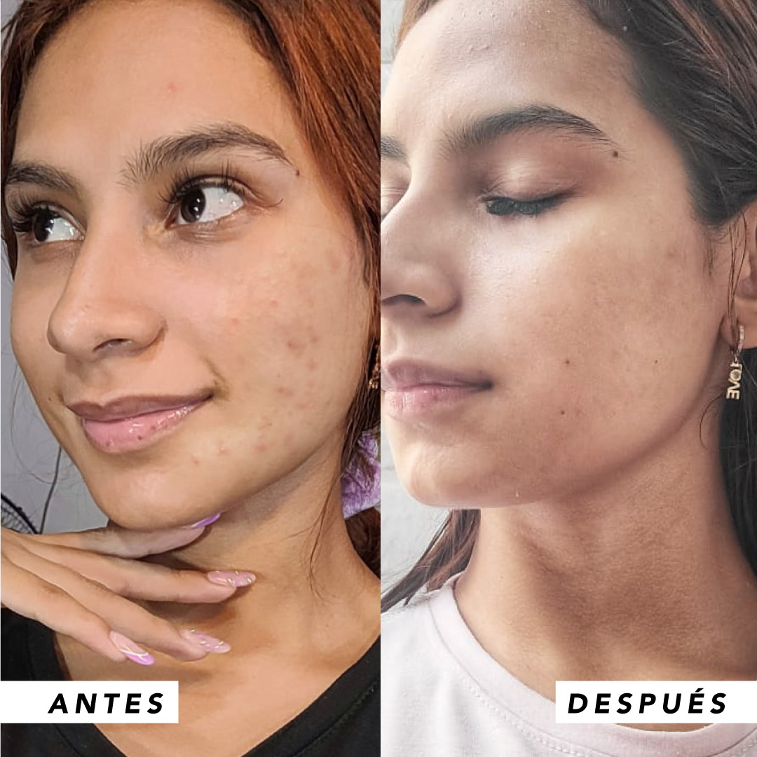 testimonio mujer infinitek paris, cambios reales en acne, arrugas, ojeras, piel, rostro, cuidado facial