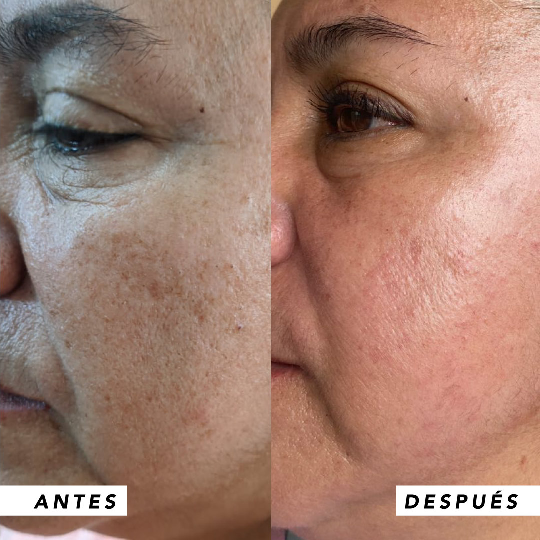 testimonio mujer infinitek paris, cambios reales en acne, arrugas, ojeras, piel, rostro, cuidado facial