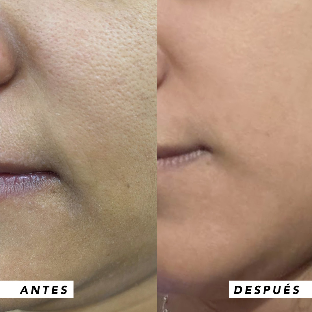 testimonio mujer infinitek paris, cambios reales en acne, arrugas, ojeras, piel, rostro, cuidado facial